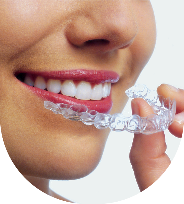 stock image of model smiling with wearing invisalign clip